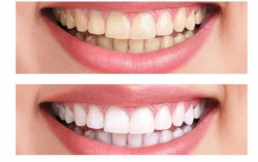 26783 teeth whitening aftercare