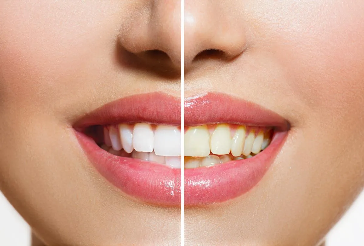 /img/26787-teeth-whitening-brandon-social-interaction.webp