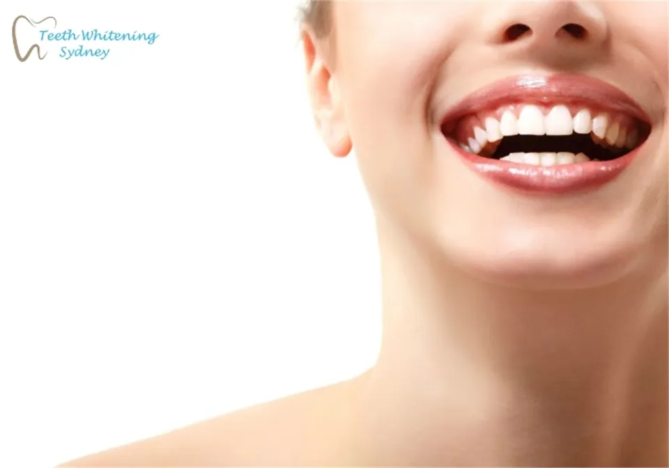 26789 professional teeth whitening