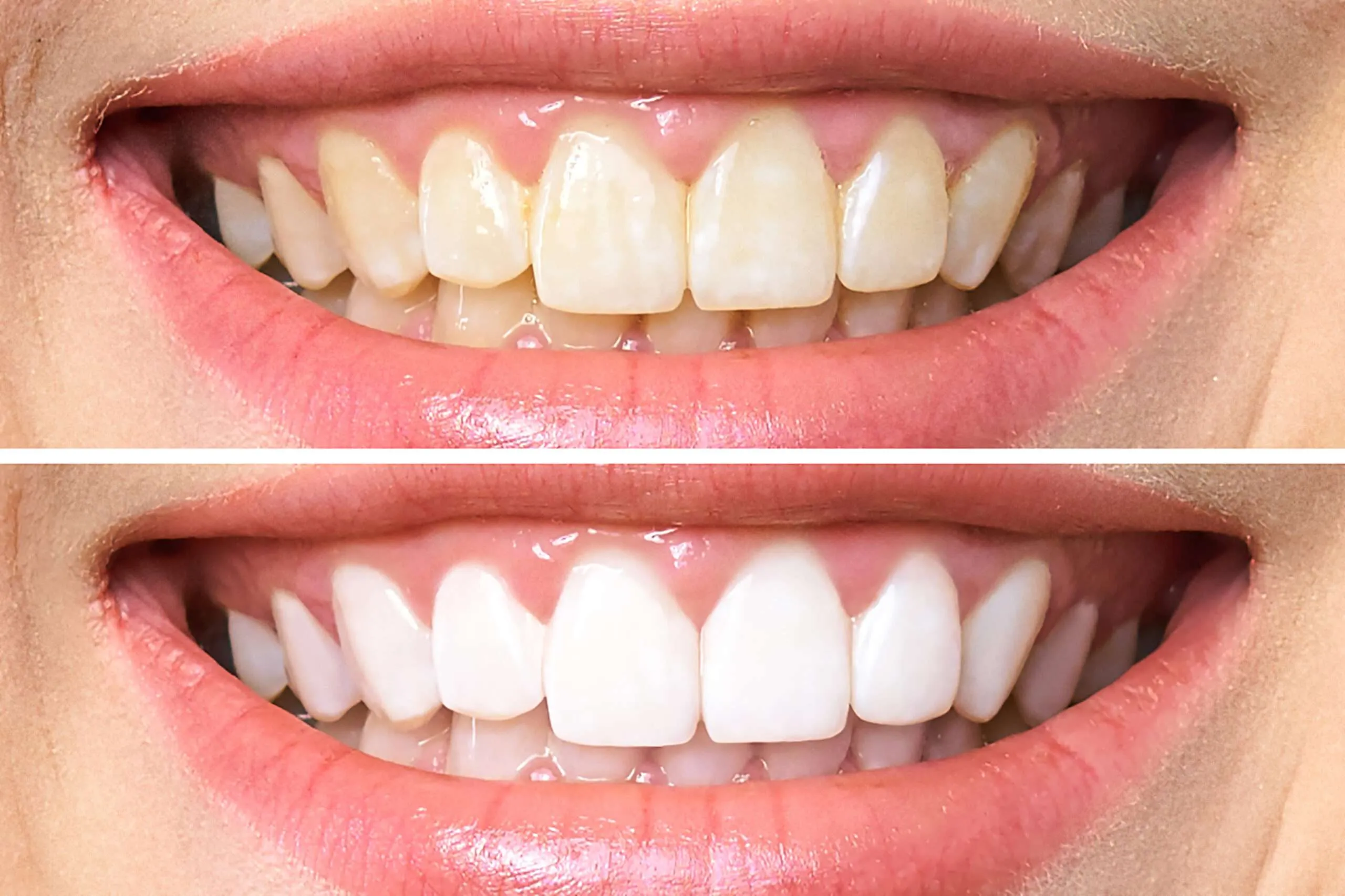 26789 teeth whitening products