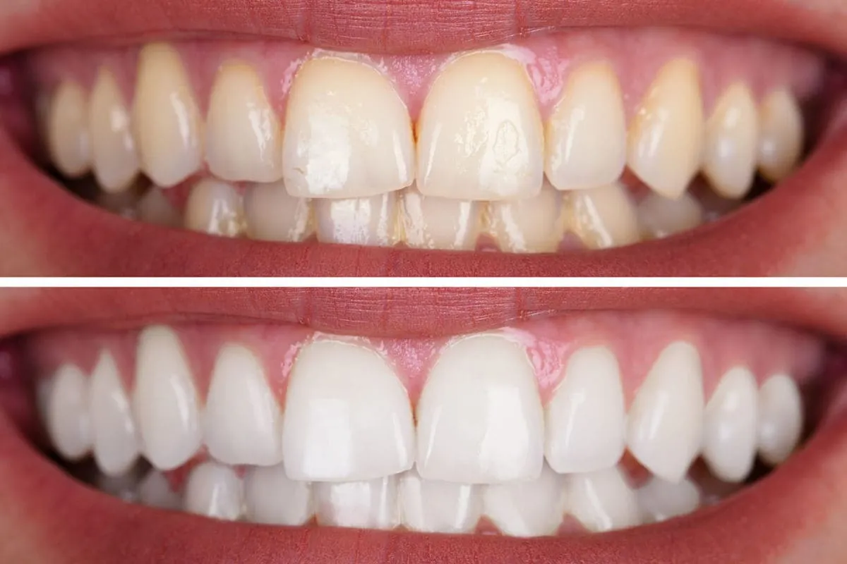 26791 teeth whitening auckland clinic