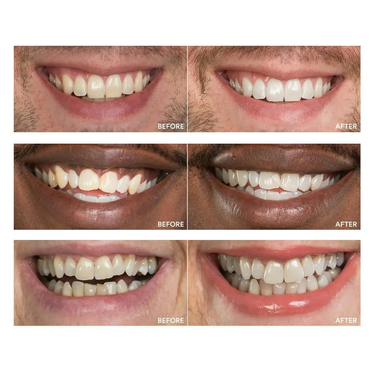 26793 at home teeth whitening